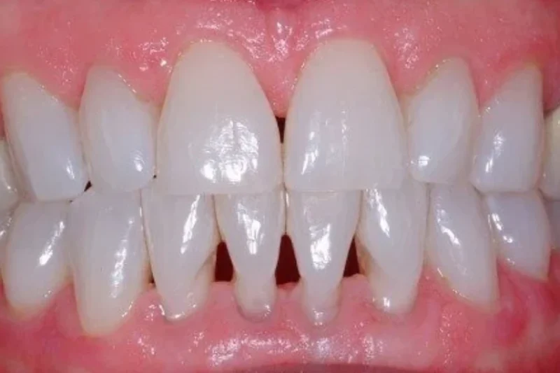 What Are the Potential Problems with Dental Bonding?